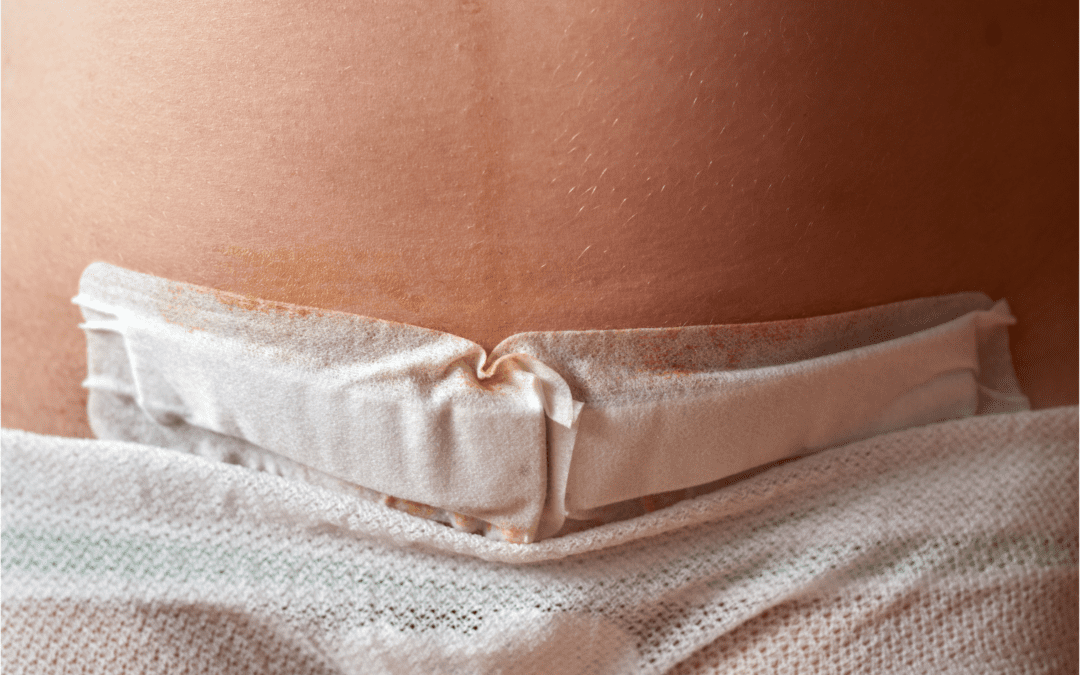 Schöne Kaiserschnittnarbe – Diese Produkte helfen dir